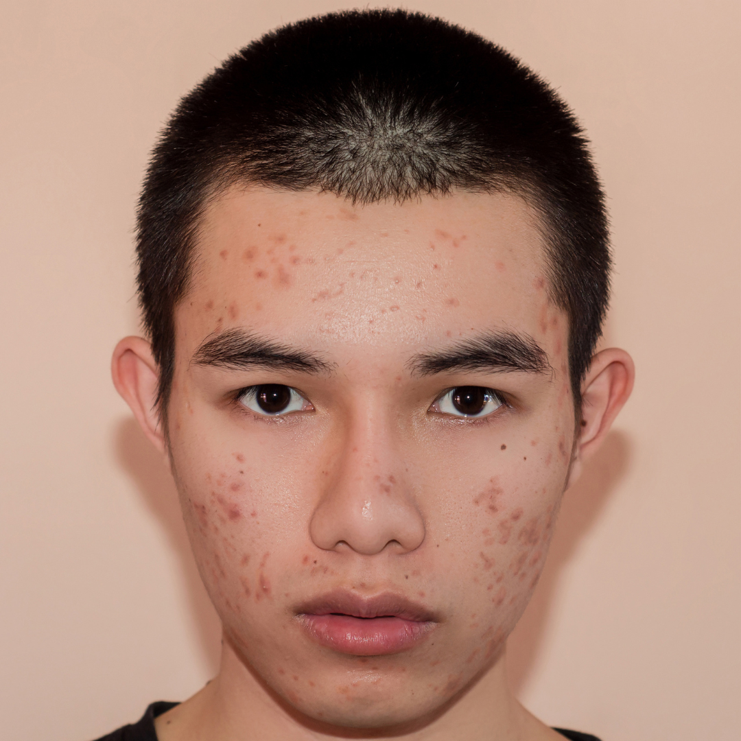 Acne Scars Before