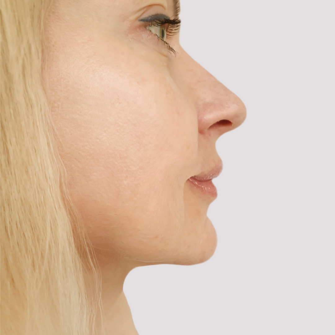 After Rhinoplasty